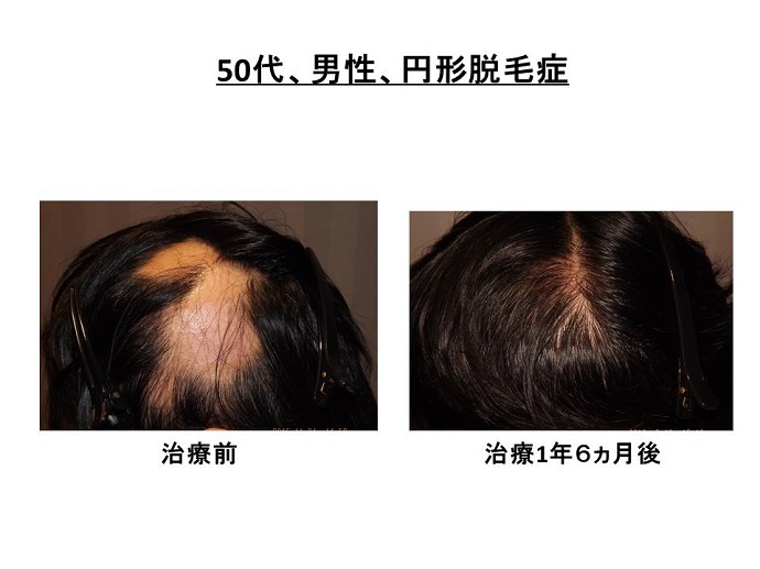 円形脱毛症　病院""